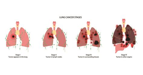 Stages Of Lung Cancer - Health365.sg