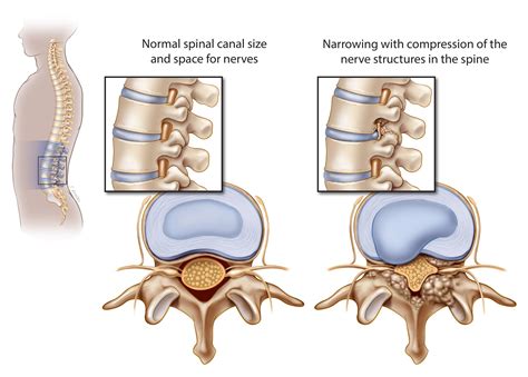 Causes Of Lumbar Spinal Stenosis