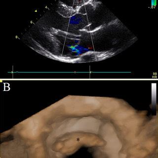 Echocardiographic images of mitral valve prolapse and myxomatous mitral ...