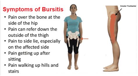 Hip Bursitis Symptoms Hip Bursitis Symptoms Bursitis Symptoms Images ...