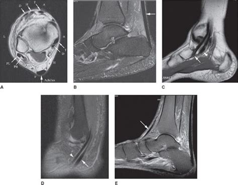 Medial Ankle Ligaments Mri