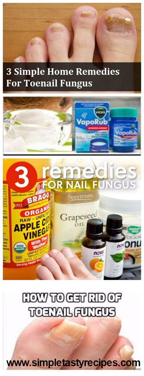 3 SIMPLE HOME REMEDIES FOR TOENAIL FUNGUS | HEALTH BLOG