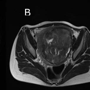 MRI scan prior to the operation | Download Scientific Diagram