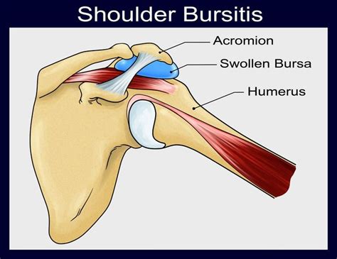 shoulder-bursitis – Neo Orthopaedic Clinic