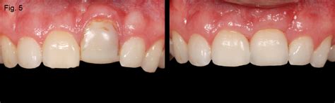 Ankylosis Part II: Treating Adults With an Ankylosed Tooth - Spear ...