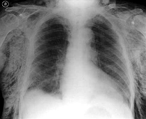 NURSEupdate: X-RAY SHOWING SURGICAL EMPHYSEMA