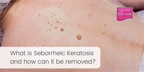 Seborrheic Keratosis removal - The Doctors Laser Clinic