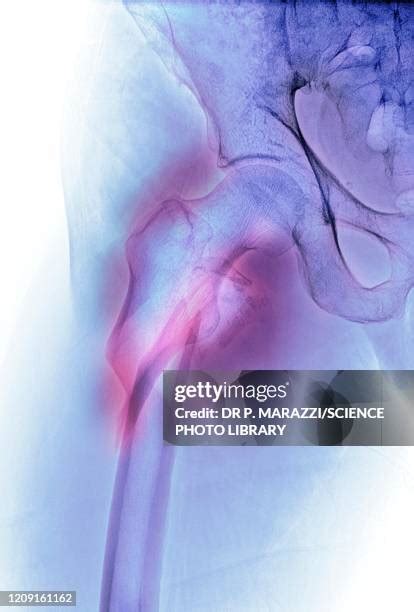 Hip Fracture X Ray Photos and Premium High Res Pictures - Getty Images