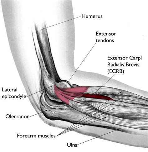 Lateral Epicondylitis (tennis elbow) - Jared Lee, MD