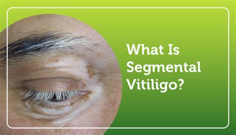 Types of Vitiligo | MyVitiligoTeam