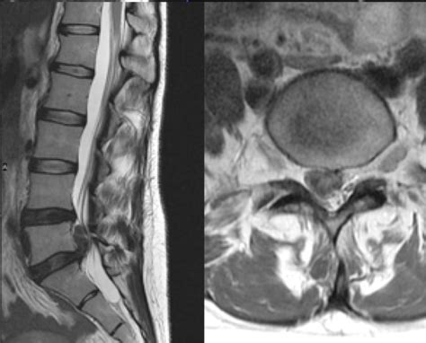 Cervical Spine MRI Herniated Disc