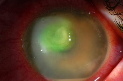 Corneal Abrasion Ulcer Treatment Harley Street | Hot Sex Picture