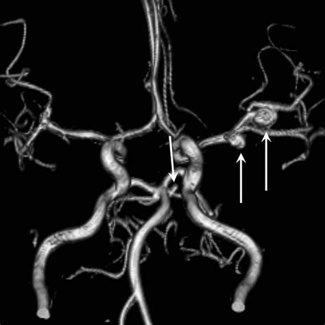 Cerebral Aneurysm Angiogram