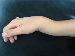 Wrist Fracture Treatment - Manchester Hand & Wrist Surgery