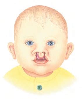 Cleft Lip & Palate Association