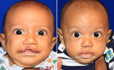 Cleft Lip Repair Photo Gallery | Nasal Deformity Repair NJ