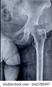 Hip Femur Fracture X Ray Stock Photo (Edit Now) 1508158916