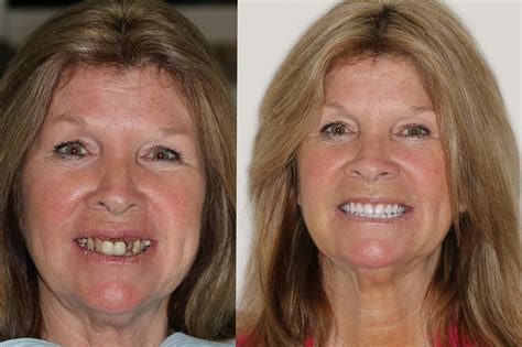 Aspen Dental Dentures Before And After - WebSelfEdit