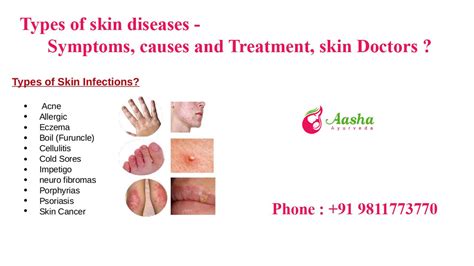 Ayurvedic Treatment for skin Diseases