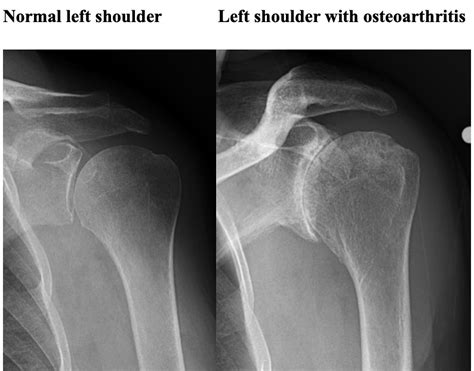 Shoulder Arthritis - University Orthopedics