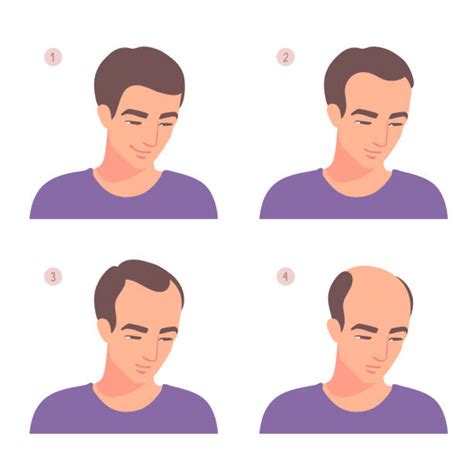 Receding Hairline Stages Signs Treatment