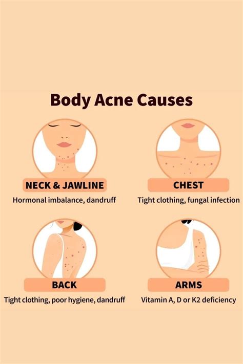 Acne Causes