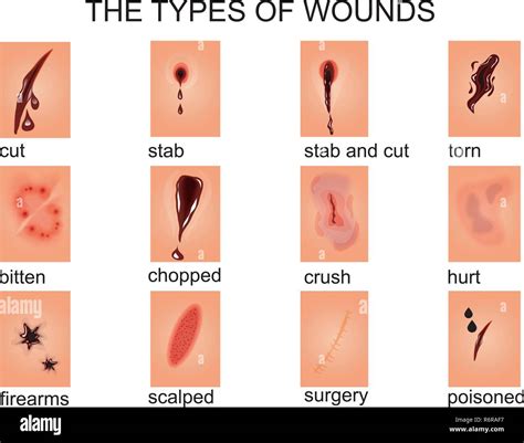 illustration of types of wounds.for medical, textbooks, publications ...