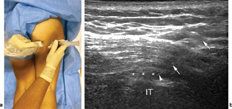 Ischial bursitis injection. (a) Simulation of probe and needle ...