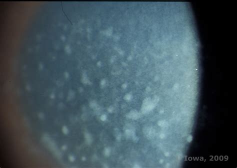 Macular Corneal Dystrophy