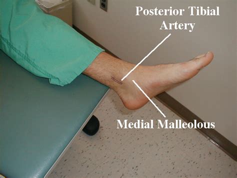 RadiologySpirit: Location of Posterior Tibial Artery