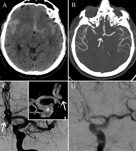 Cerebral Aneurysm Angiogram