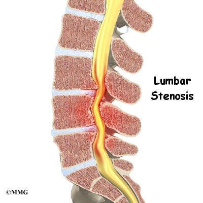 Lumbar Spinal Stenosis