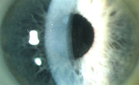 Fuchs corneal endothelial dystrophy