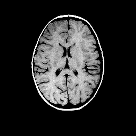 Normal MRI Scan Of Brain