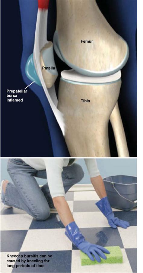 Prepatellar Bursitis (Kneecap Bursitis) - Orthoriverside.com