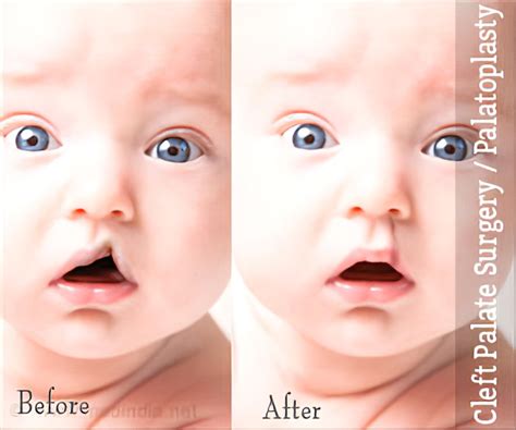 Cleft Lip Surgery Before And After