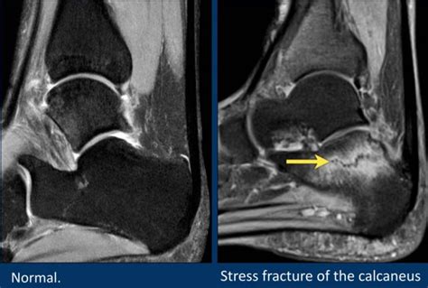 The Radiology Assistant : MRI examination of the ankle