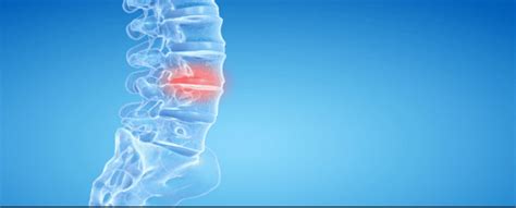 What’s the Best Treatment for Degenerative Disc Disease? | Stemedix