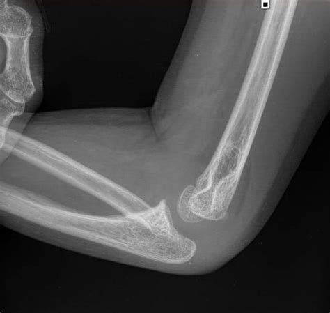 Congenital Radial Head Dislocation - Hand - Orthobullets