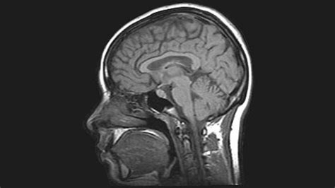 ESA - MRI brain scan