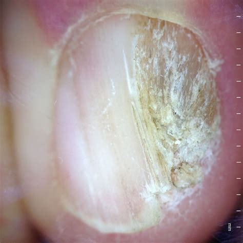 Acral Lentiginous Melanoma Nail Symptoms - Nail Ftempo