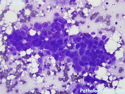 adenocarcinoma pancreas cytology