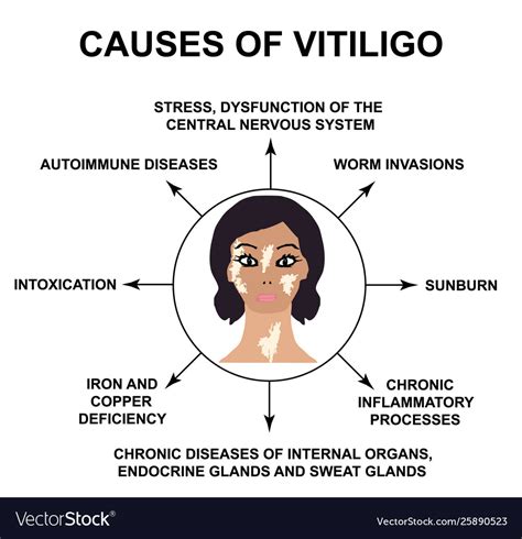 Causes vitiligo world vitiligo day Royalty Free Vector Image