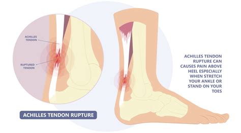 Pulled Calf Muscles: Causes and Treatments - Sport Doctor London