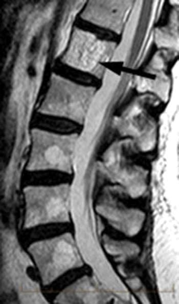 RadiologySpirit: Atypical hemangioma