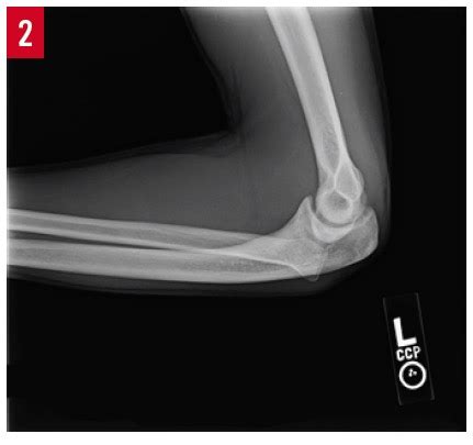 Congenital Posterior Dislocation of the Radial Head | Consultant360