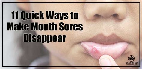 11 Quick Ways to Make Mouth Sores Disappear | Elevated Dental