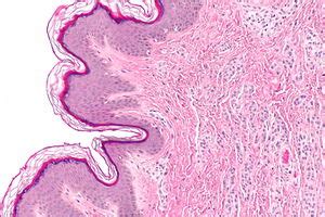 Intradermal nevus - Libre Pathology