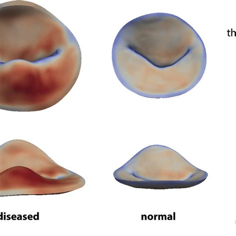 (PDF) Modeling the Myxomatous Mitral Valve With Three-Dimensional ...