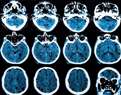 Mri Brain Scan stock photo. Image of convolutions, bone - 46086390